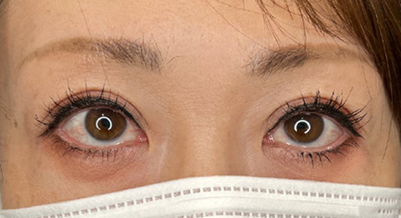上まぶたたるみ取り,上まぶたのたるみ取りで二重のラインも整えた症例写真,After（メイクあり）<br/>
（3ヶ月後）,