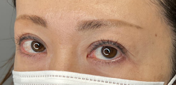上まぶたたるみ取り,上まぶたのたるみ取りで二重のラインも整えた症例写真,After（3ヶ月後）,ba_tarumi020_b02.jpg