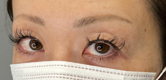 上まぶたたるみ取り,上まぶたのたるみ取りで二重のラインも整えた症例写真,Before,ba_tarumi020_b02.jpg
