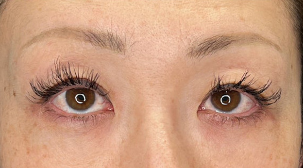 上まぶたたるみ取り,上まぶたのたるみ取りで二重のラインも整えた症例写真,施術前,mainpic_tarumi020a.jpg