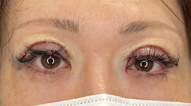上まぶたたるみ取り,上まぶたのたるみ取りで二重のラインも整えた症例写真,施術直後,mainpic_tarumi020b.jpg