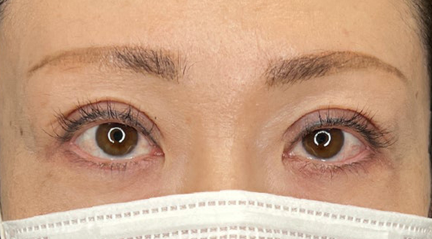 上まぶたたるみ取り,上まぶたのたるみ取りで二重のラインも整えた症例写真,1ヶ月後,mainpic_tarumi020c.jpg