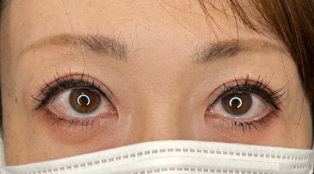 上まぶたたるみ取り,上まぶたのたるみ取りで二重のラインも整えた症例写真,3ヶ月後,メイクあり,mainpic_tarumi020e.jpg