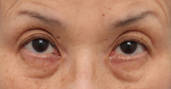 目の下のたるみ・黒クマに対して表ハムラ法を行った70代女性の症例写真,Before,ba_hamra004_b01.jpg
