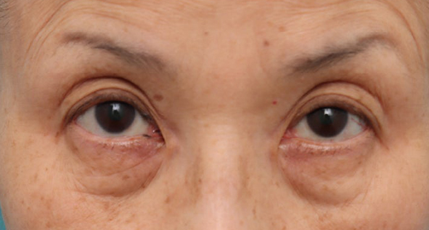 表ハムラ・裏ハムラ法,目の下のたるみ・黒クマに対して表ハムラ法を行った70代女性の症例写真,施術前,mainpic_hamra004a.jpg