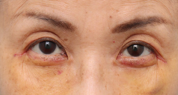 表ハムラ・裏ハムラ法,目の下のたるみ・黒クマに対して表ハムラ法を行った70代女性の症例写真,1週間後,mainpic_hamra004b.jpg