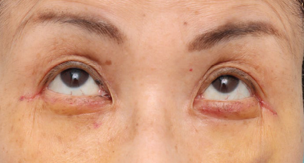 表ハムラ・裏ハムラ法,目の下のたるみ・黒クマに対して表ハムラ法を行った70代女性の症例写真,1週間後,mainpic_hamra004e.jpg