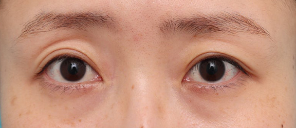 二重まぶた・埋没法を行ったことがある患者様に、二重まぶた・全切開法を行った症例写真,After（3ヶ月後）,ba_sekkai119_a01.jpg