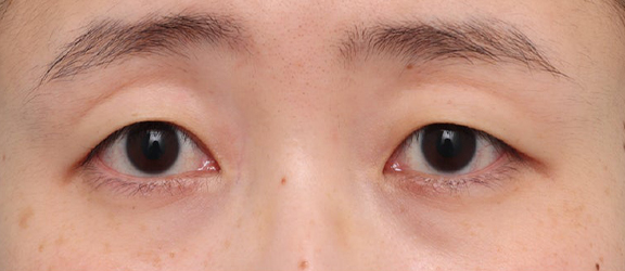 二重まぶた・埋没法を行ったことがある患者様に、二重まぶた・全切開法を行った症例写真,Before,ba_sekkai119_b01.jpg