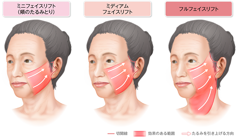 切開線 たるみが上がる方向 効果のある範囲